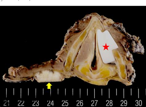 [Preoperative evaluation in thyroplasty: the laryngeal lateral 